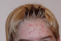 Imatge relacionada amb acne