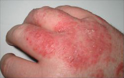 Imatge relacionada amb èczema