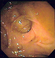 Imatge relacionada amb diverticulosi