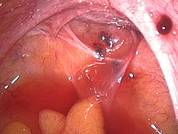 Imatge relacionada amb endometriosi